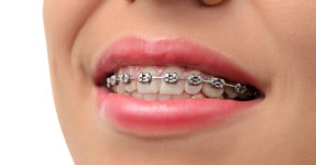 metal braces for adults