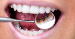 lingual-braces-for-adult