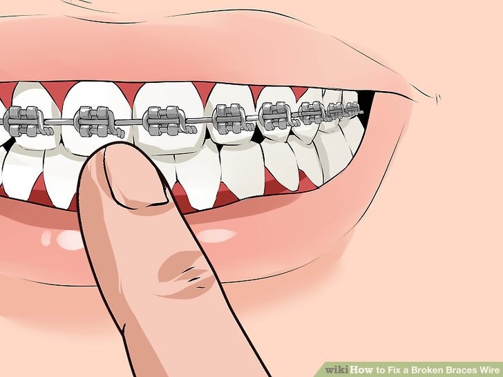 How to Fix a Broken Braces Wire: 6 Simple Ways